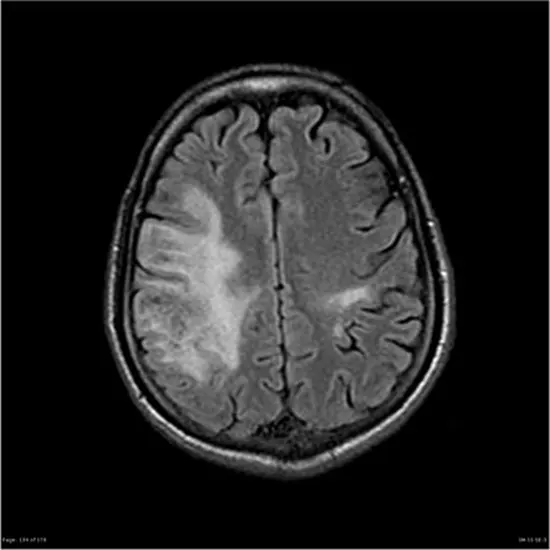 Progressive Multifocal Leukoencephalopathy
